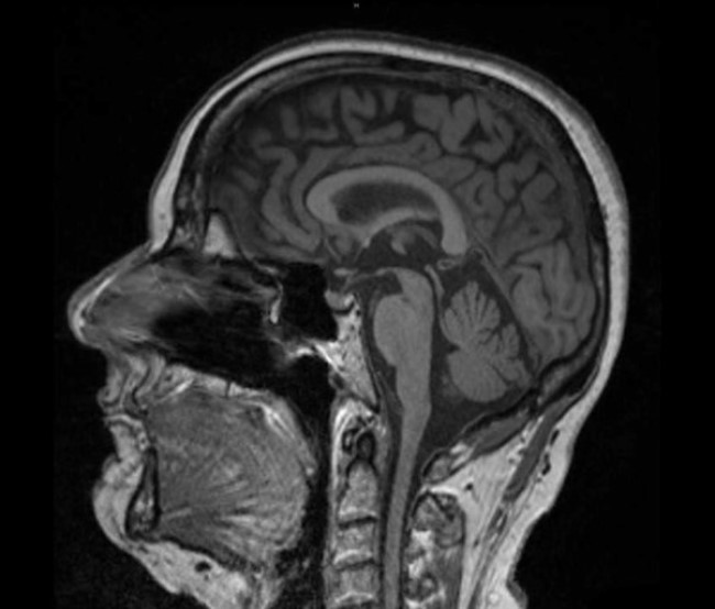 МР-скан головы в сагиттальной проекции