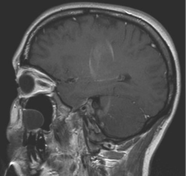 МРТ лицевой зоны: образование гайморовой пазухи