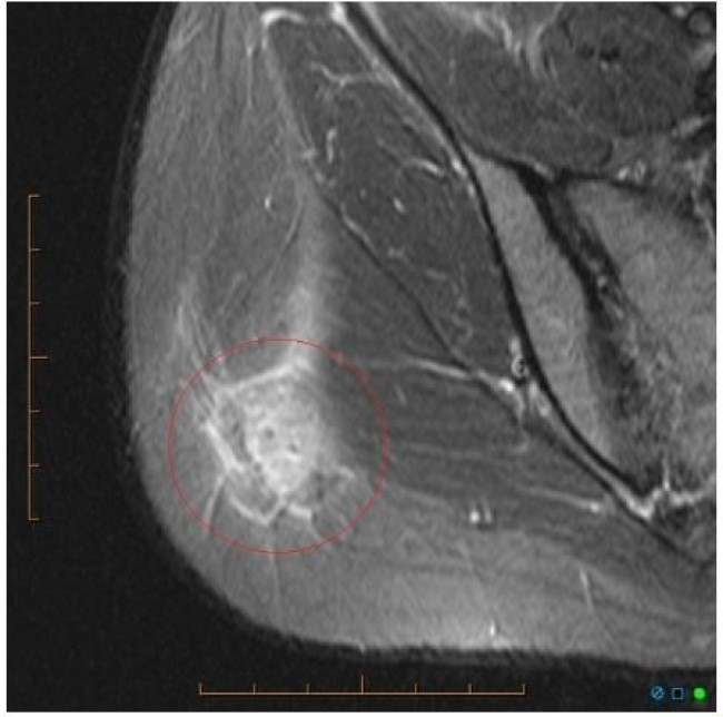 Некроз, расположенный в мягких тканях ягодичной области, на снимке МРТ