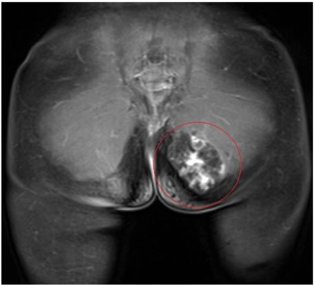 На снимке МРТ мягкие ткани ягодиц после введения контрастного препарата: слева определяется объемное новообразование в большой ягодичной мышце, имеющее неровные, четкие контуры (гемангиома?)