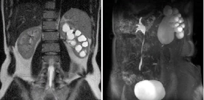 МР-урография: гидронефроз слева, стеноз лохапночно-мочеточникового сегмента