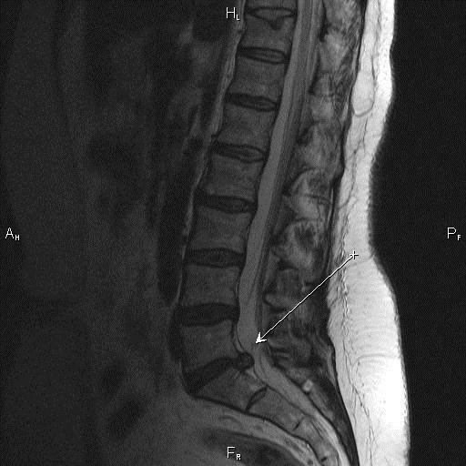 МРТ обсуждаемой анатомической области. На снимке визуализируется грыжа диска L5-S1 (указана стрелкой) со стенозом спинномозгового канала
