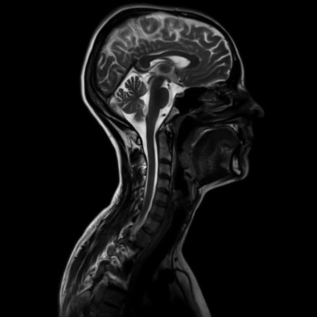 При жалобах пациента на головные боли МРТ шейного отдела позвоночного столба могут дополнить магнитно-резонансной томографией внутричерепных тканей