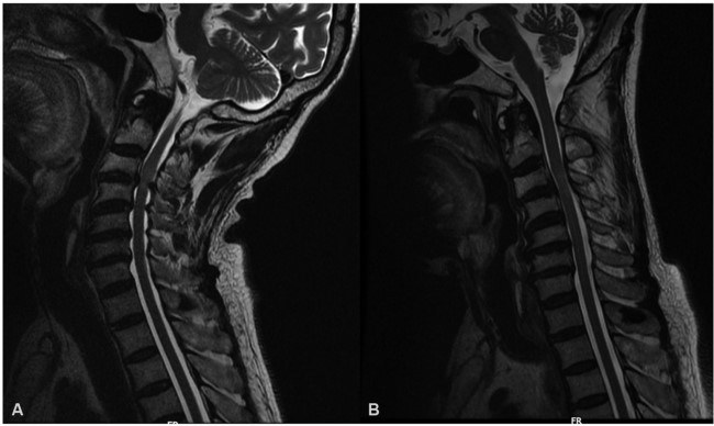 Магнитно-резонансная томография шейно-грудного отдела: участки стеноза спинномозгового канала