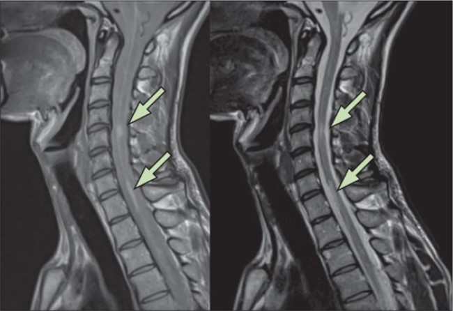 МРТ шейного и верхнегрудного отдела в сагиттальной проекции: участки поражения спинного мозга (указано стрелками) - рассеянный склероз