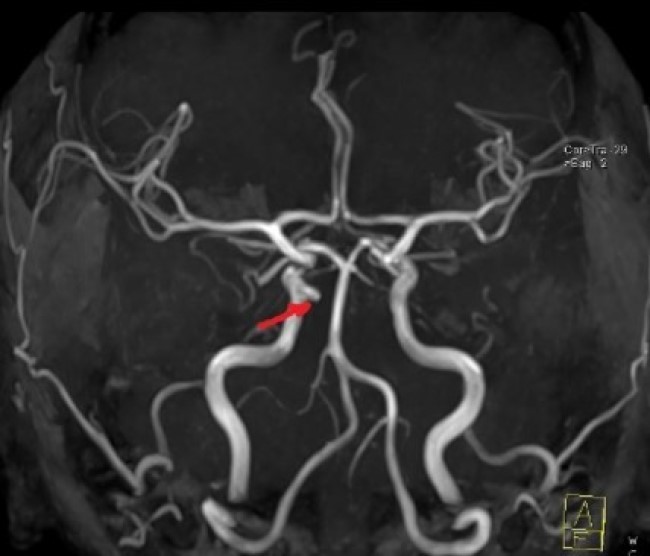 На изображении, полученном в результате МР-томографии, вдоль медиальной стенки правой внутренней сонной артерии отмечается аневризма (обозначена стрелкой)