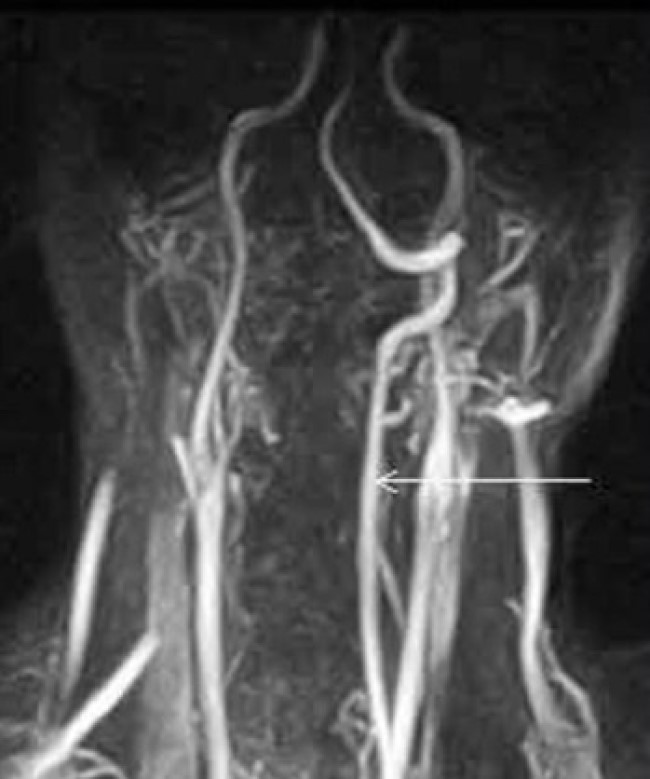 Гипоплазия правой позвоночной артерии, слева (стрелка) - вариант нормы