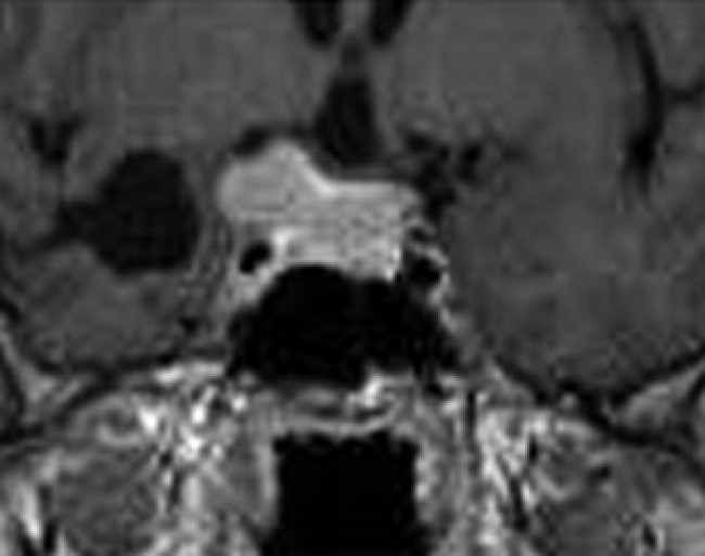 МРТ турецкого седла обнаруживает аденомы питуитарной железы, которые являются самыми частыми образованиями основания черепа