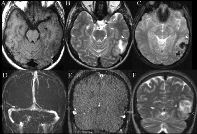 МРТ головного мозга в аксиальных и фронтальных проекциях: слева в височной доле определяется инсульт венозного генеза