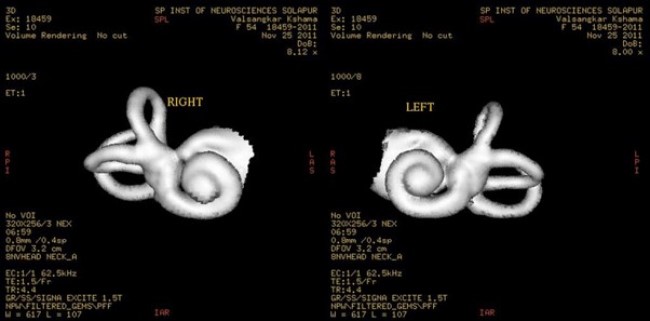 МРТ 3D-реконструкция внутреннего уха