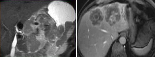 Запущенное новообразование (стадия Т4) тела желудка с метастазами на МРТ